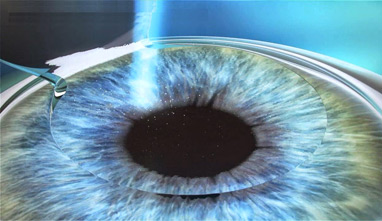 oftalmologo - cirugia refractiva
