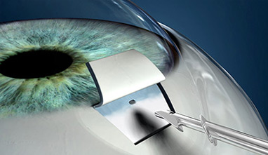 oftalmologo cirugia de glaucoma