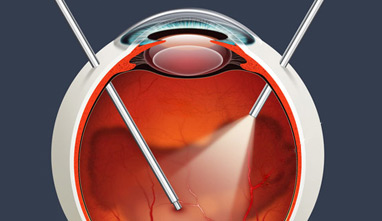 Tratamiento de la Retinopatía Diabética. Cirugía de retina
